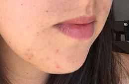 acne skincare case study before CM