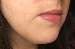 acne skincare case study after IL