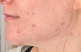 acne skincare case study before EB