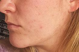 acne skincare case study after EB