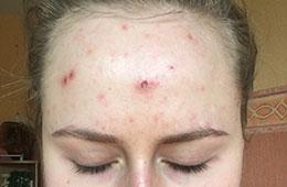 acne skincare case study before IL