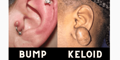 piercing bump vs keloid