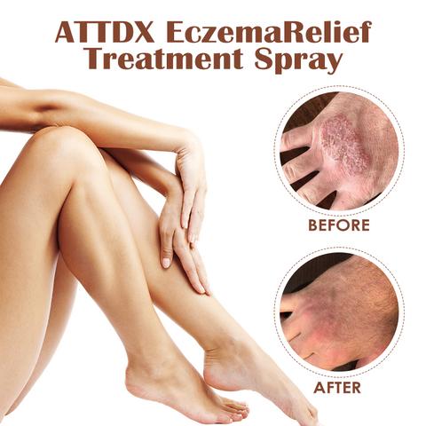 ATTDX EczemaRelief Treatment Spray