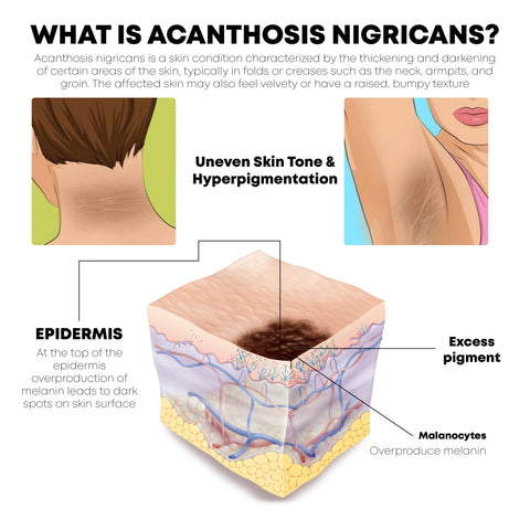 ATTDX AcanthosisNigricans Treatment Oil