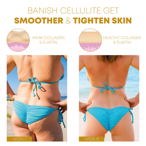 Post Pregnancy Cellulite Treatment and Skin Tightening - Feel Good