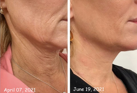 REMEDIALX CollagenFirming Neck Cream