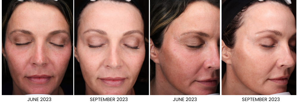 Before and After photos taken with a Visia camera show the results of 3 months of tranexamic acid use. Results include overall skin improvement, reduced hyperpigmentation and reddness.
