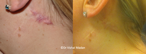 Keloid Scars treatment before and after