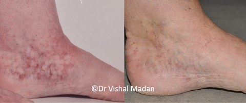 Leg Thread Veins treatments