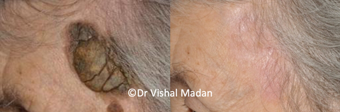 Seborrhoeic Keratoses treatment before and after