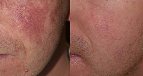 Facial Redness laser treatment before and after