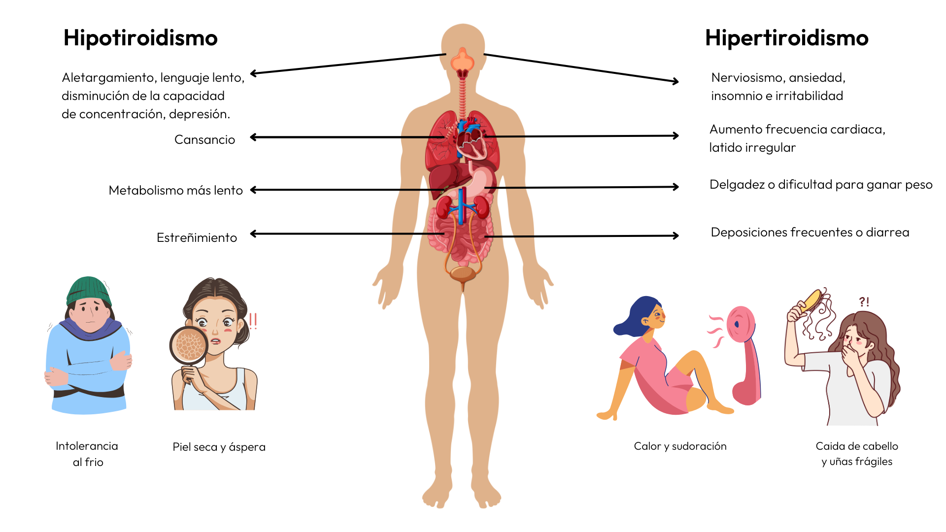 Diferencias entre el Hipotiroidismo y el Hipertiroidismo