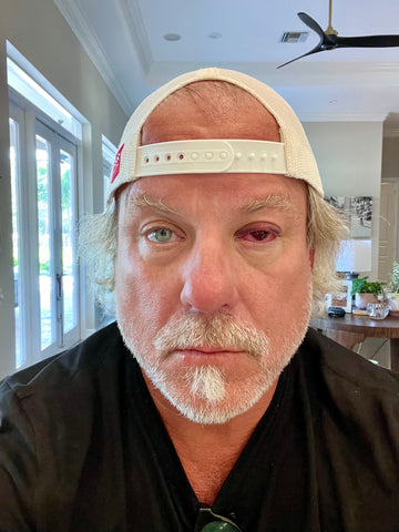 pickleball eye injury