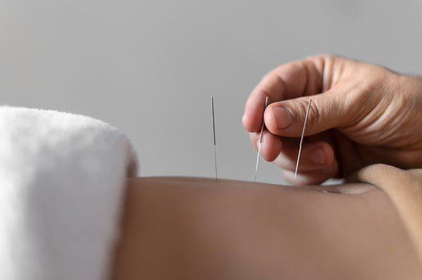 A hand placing needles in a person's back