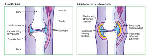 arthritic knee pain