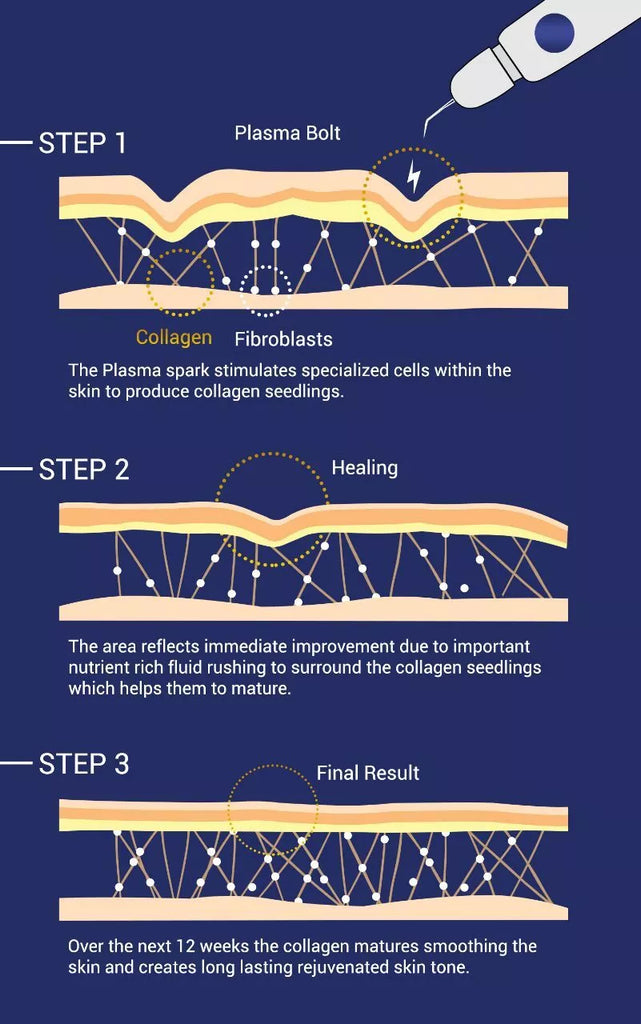 Fibroblast Skin Tightening