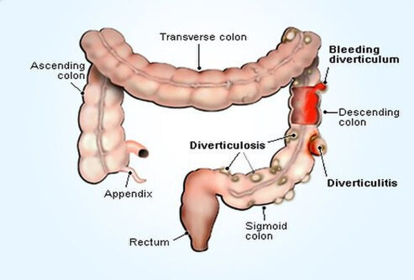 Probiotics for Diverticulitis NZ