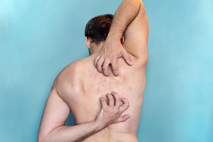 Unveiling_the_Culprits_What_Causes_Back_Acne_in_Males_720x_5c03ebbb-f820-41f5-a1da-9a5255c642b5