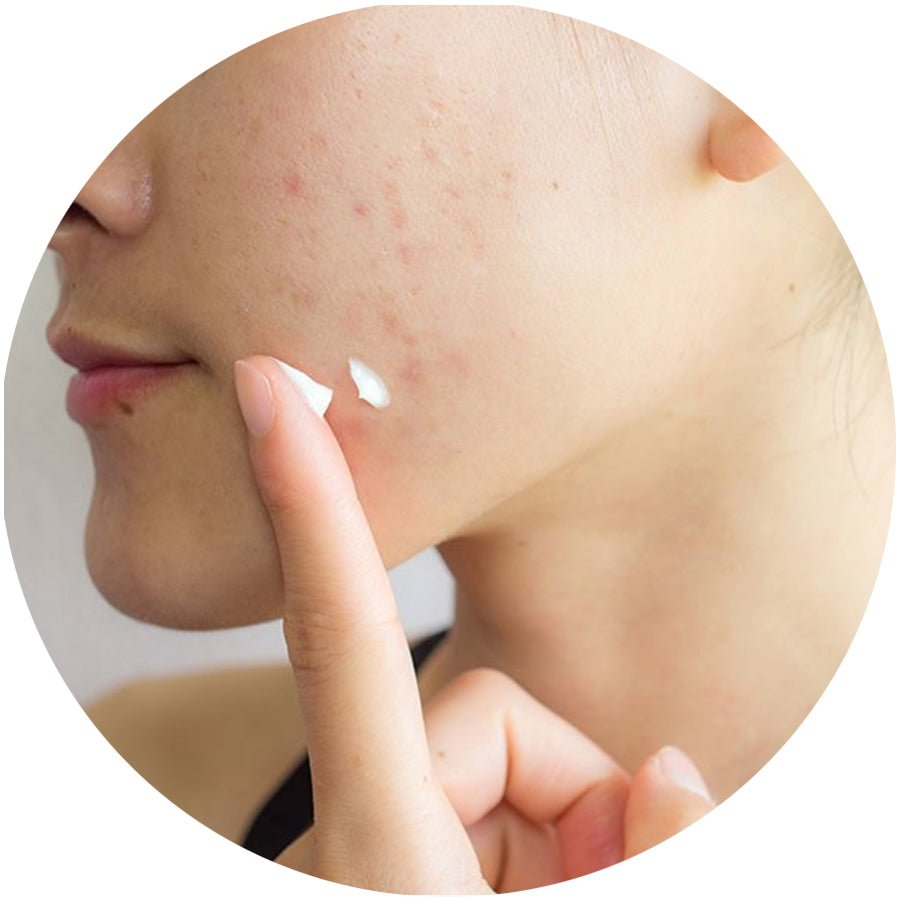 Repairing Acne-Prone Skin
