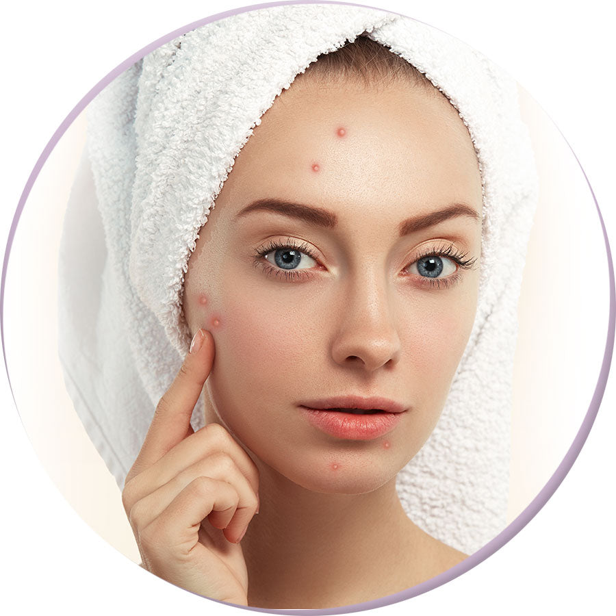 Repairing Acne-Prone Skin