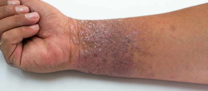 eczema black skin causes