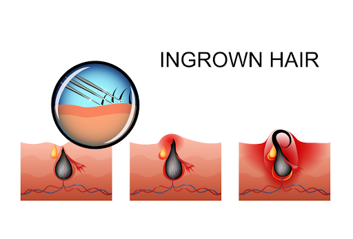 What is an ingrown hair