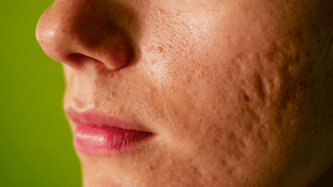 Sebaceous Filaments on Face