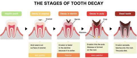 The stages of tooth decay : Health Tooth -> Decay in enamel -> Decay in dentin -> Decay in pulp -> Dead tooth