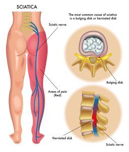 Get This Specialty Massage for Back, Hip and Leg Pain – DR-HO'S