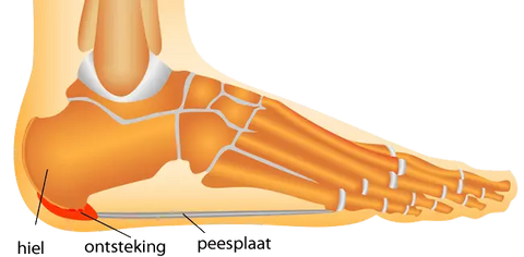 Hielpijn fasciitis plantaris