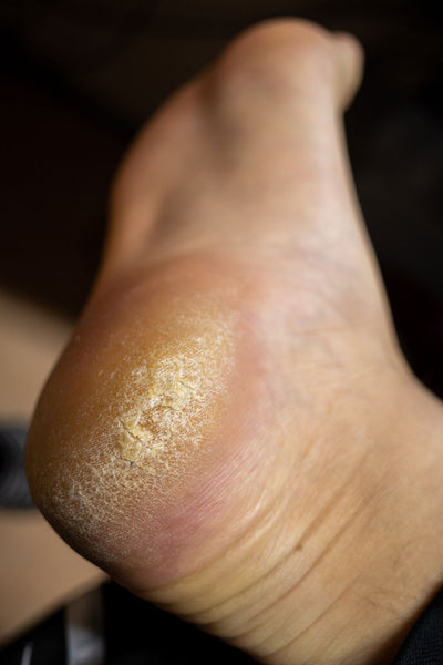 Foto eines nackten Fußes mit dicker Hornhaut an der Ferse