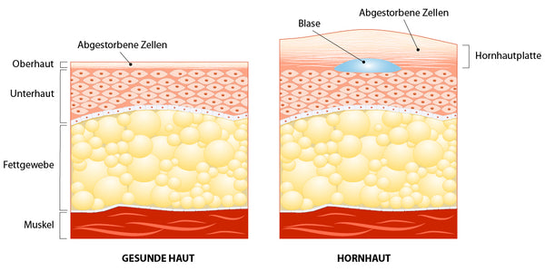 Schema der Haut grafisch dargestellt mit und ohne Blase