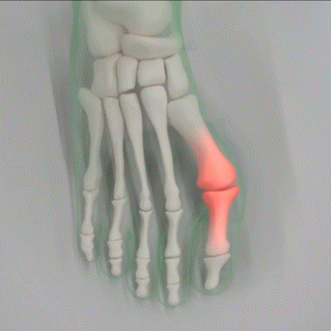 Toe Correction GIF