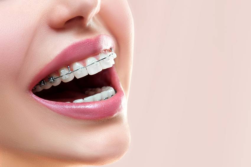 A Complete Guide to Teeth Straightening in NZ