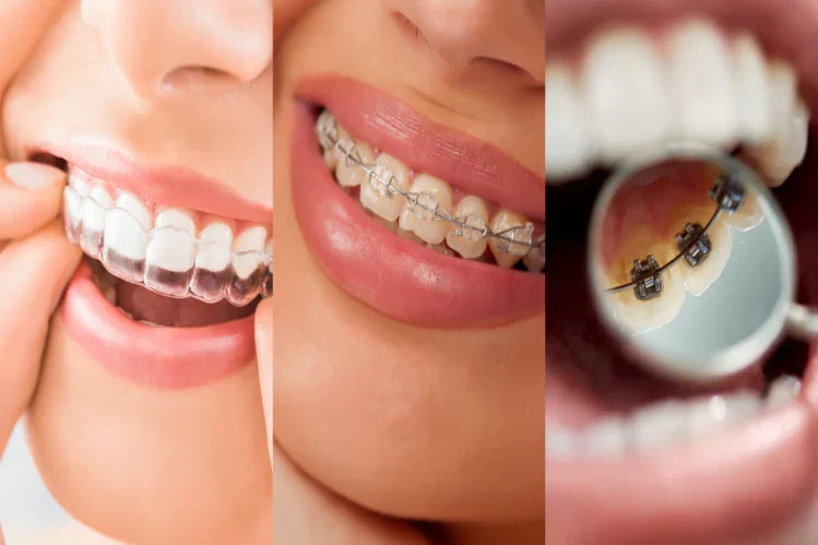 Teeth straightening options - clear aligner, ceramic braces, and lingual braces.