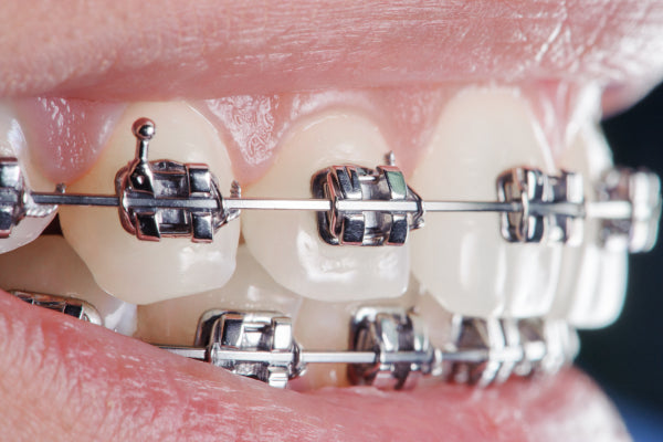 closeup of teeth with traditional braces