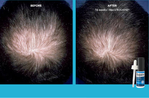 Before & After Rogaine Minoxidil 5% Topical solution