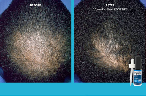 Before & After Rogaine Minoxidil 5% Topical solution