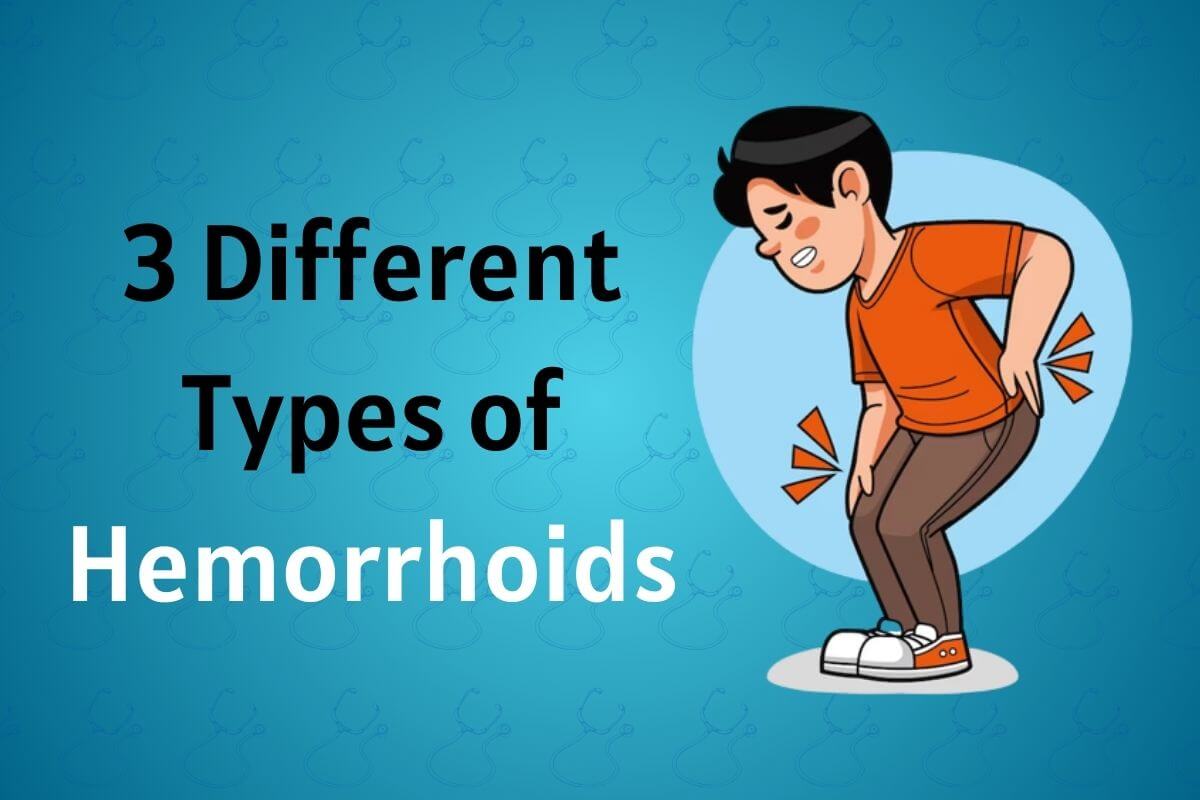 3 Different Types of Hemorrhoids