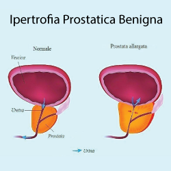 prostata ingrossata