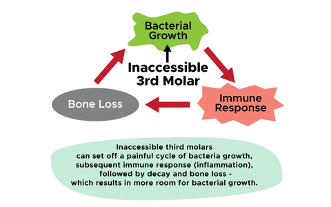 Inaccessible wisdom teeth and cycle of bacterial growth, infection, pain and bone loss