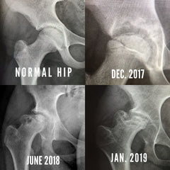 the stages of Katya's hip disease