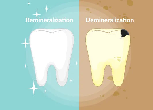 Remineralization