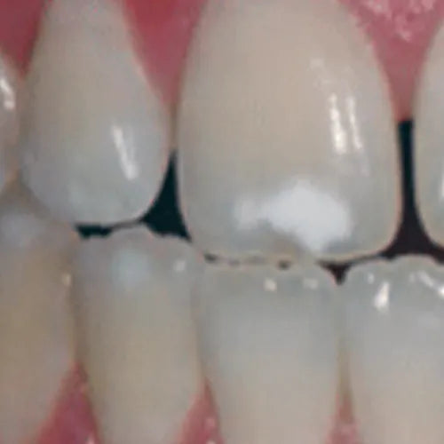 white spot lesions.webp__PID:c253550f-5219-4aae-b880-71cf91815ade