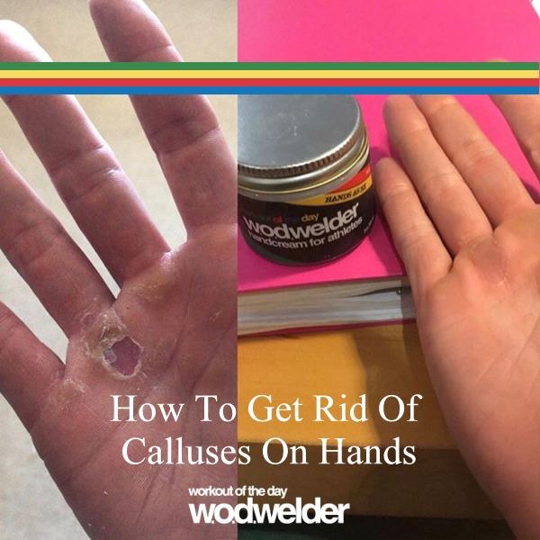How to get rid of calluses on hands