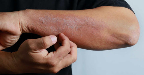What is a Skin Disease