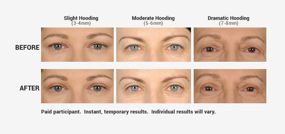 Non-surgical eye lifts can also be used to address asymmetrical eyes, especially when one eyelid droops more than the other 