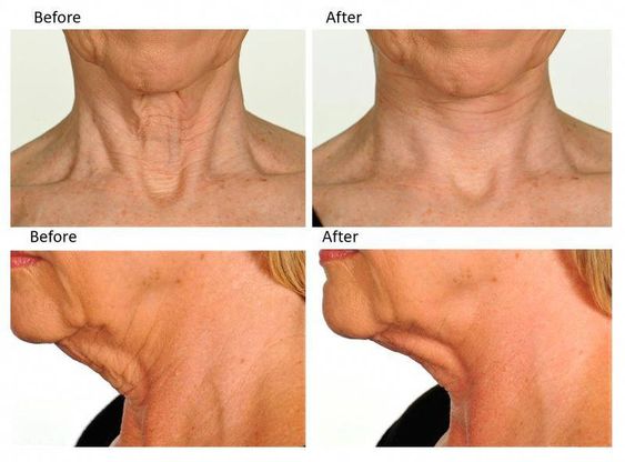 Non-invasive ways to get a temporary neck lift, then try our NECK RESCUE correcting strips - Contours Rx®
