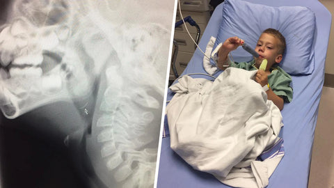 Xray image of bbq brush metal bristle stuck in throat of child. Image on the right is of the child who just had emergency surgery to remove the metal bristle from his throat.