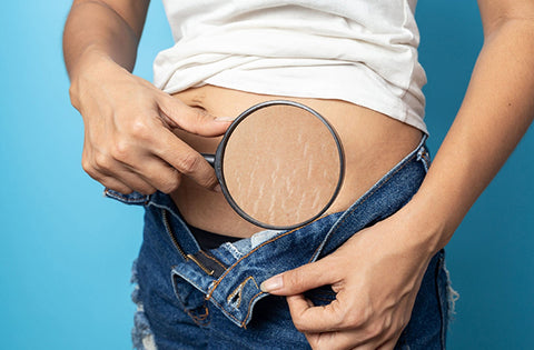 Girl is seeing the stretch marks through magnifying glass